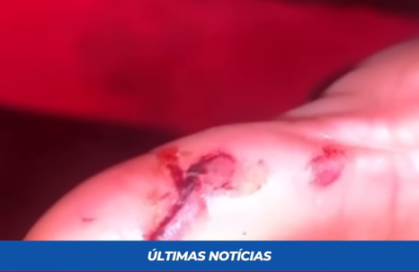 Mulher é atacada por cachorro em Apuarema e moradores cobram providências Mulher é atacada por cachorro em Apuarema e moradores cobram providências